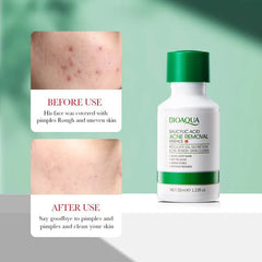 BIOAQUA Salicylic Acid Acne Removal Essence Serum - 35ml Bioaqua