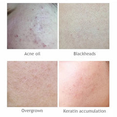AICHUN BEAUTY Salicylic Acid Purifying Shrink Pores Exfoliation Aichun Beauty