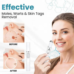 Non-Invasive Mole and Wart Removal Pen Cosmia.pk