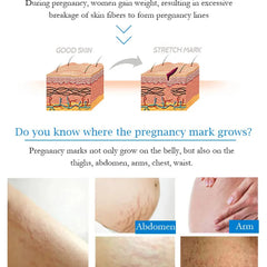 Guanjing Remove Stretch Marks Cream - 80g Guanjing