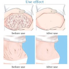 Guanjing Remove Stretch Marks Cream - 80g Guanjing