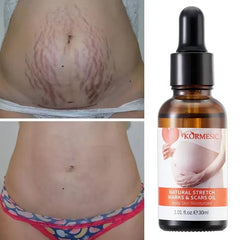 KORMESIC Skincare for Natural Belly Care Remover Stretch Mark Oil - 100ml KORMESIC