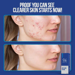 Wiki Special Anti Acne Serum - 30ml Wiki