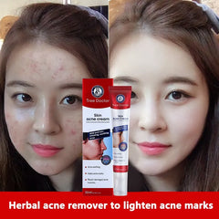 Tree Doctor Skin Acne Cream - 30g Tree Doctor