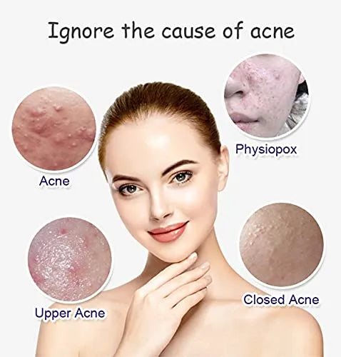 Aichun beauty Anti Acne Whitening Facial Serum - 30ml Aichun Beauty