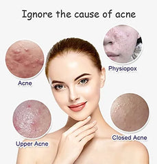 Aichun beauty Anti Acne Whitening Facial Serum - 30ml Aichun Beauty