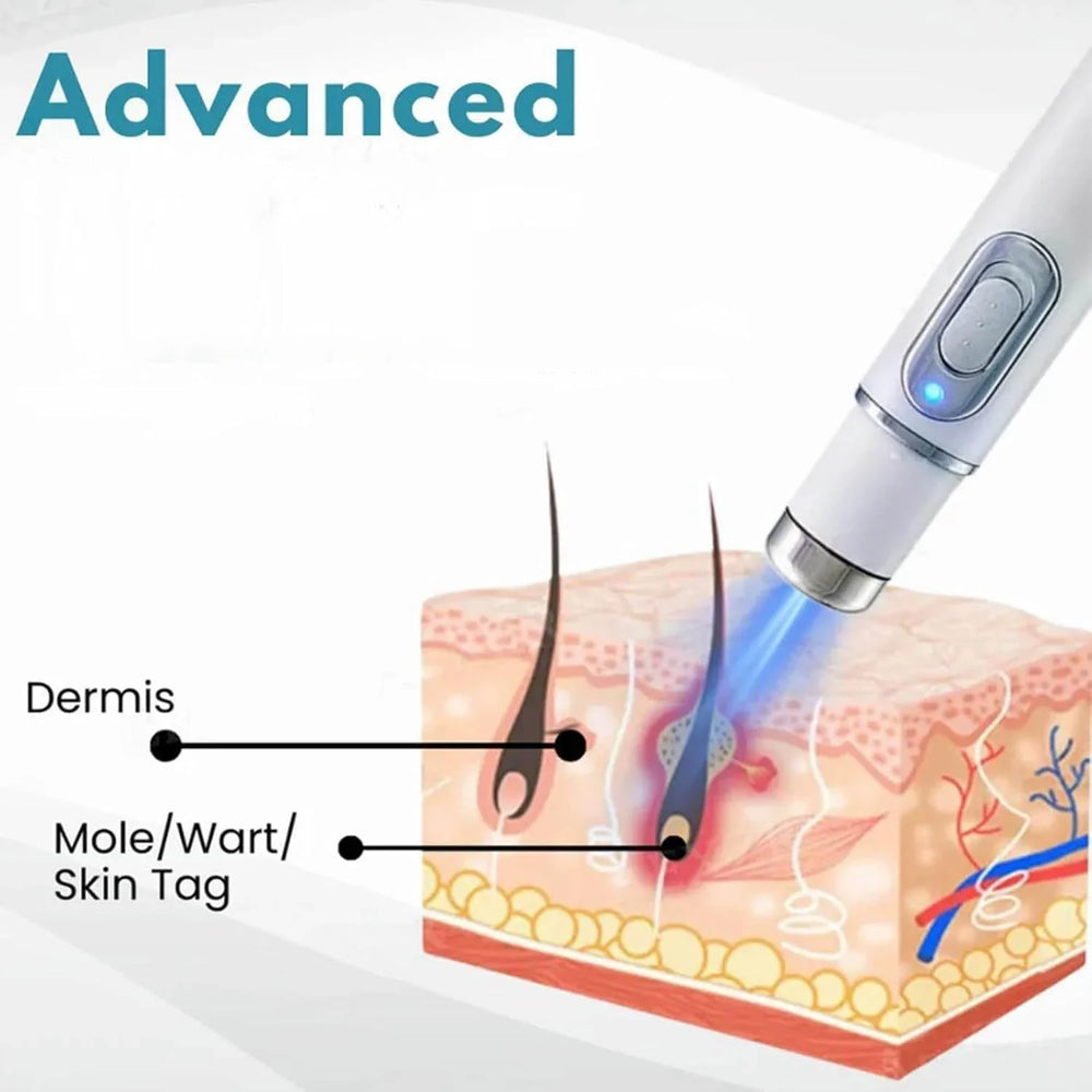 Non-Invasive Mole and Wart Removal Pen Cosmia.pk