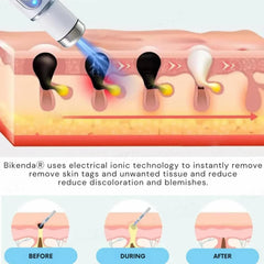 Non-Invasive Mole and Wart Removal Pen Cosmia.pk