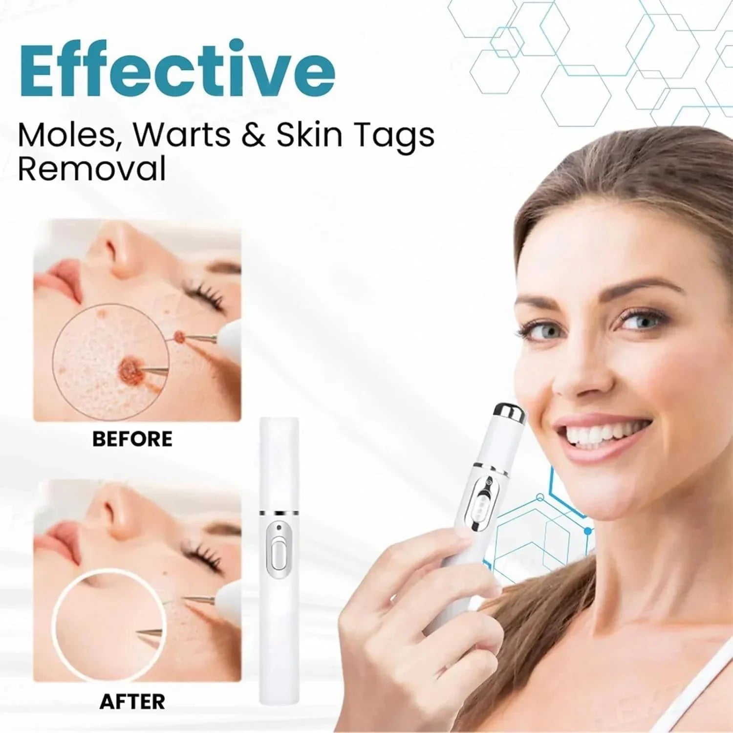 Non-Invasive Mole and Wart Removal Pen Cosmia.pk