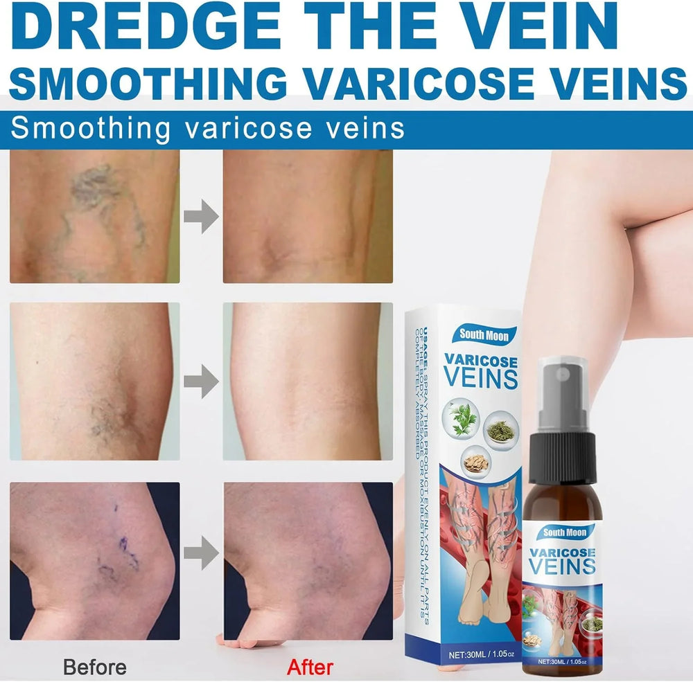 South Moon Vein Healing Varicose Veins Treatment Spray - 30ml South Moon