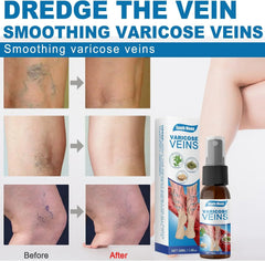 South Moon Vein Healing Varicose Veins Treatment Spray - 30ml South Moon