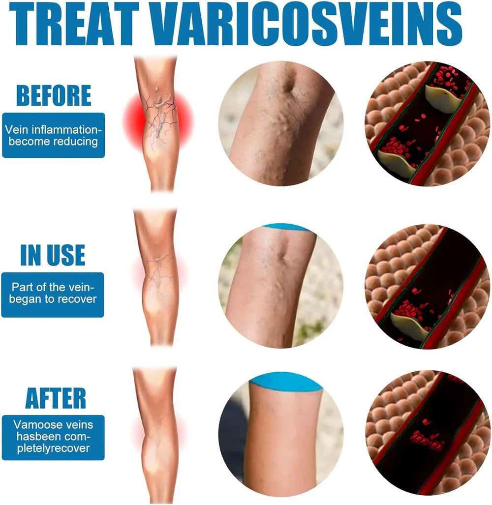 South Moon Vein Healing Varicose Veins Treatment Spray - 30ml South Moon