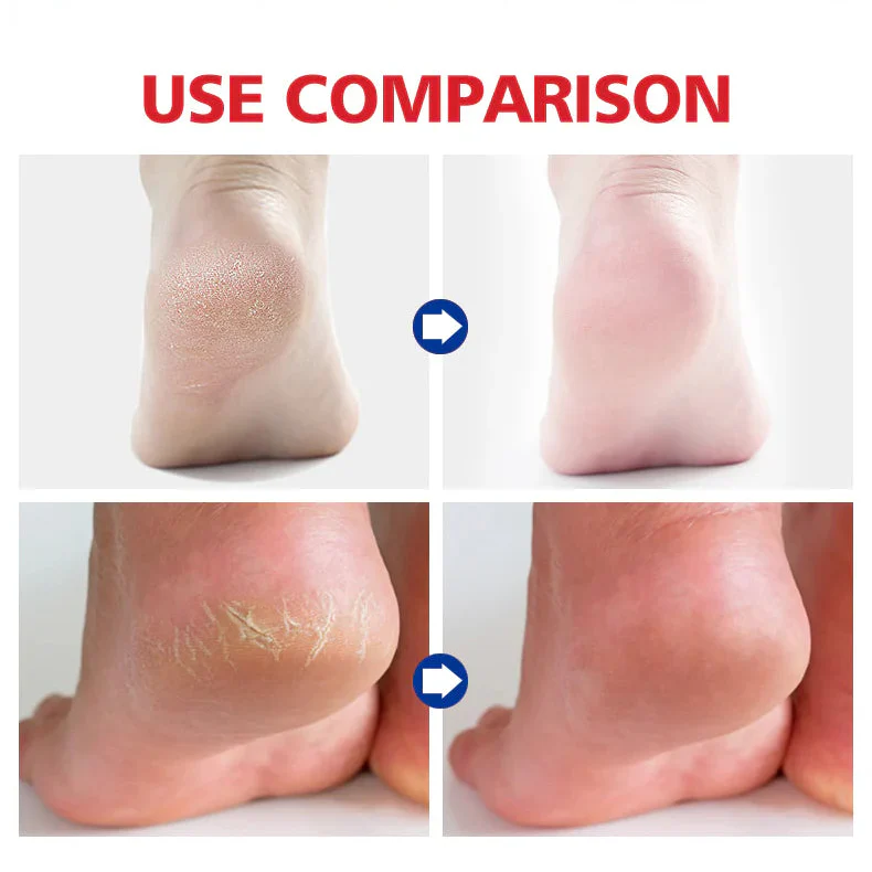 Aichun Beauty Foot Balm For Heel Cream– 20g Aichun Beauty