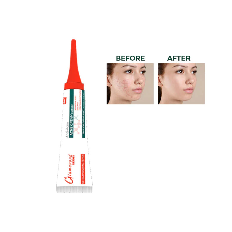 Glamorous Face Anti Acne Cream Glamorous Face