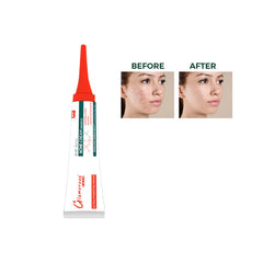 Glamorous Face Anti Acne Cream Glamorous Face
