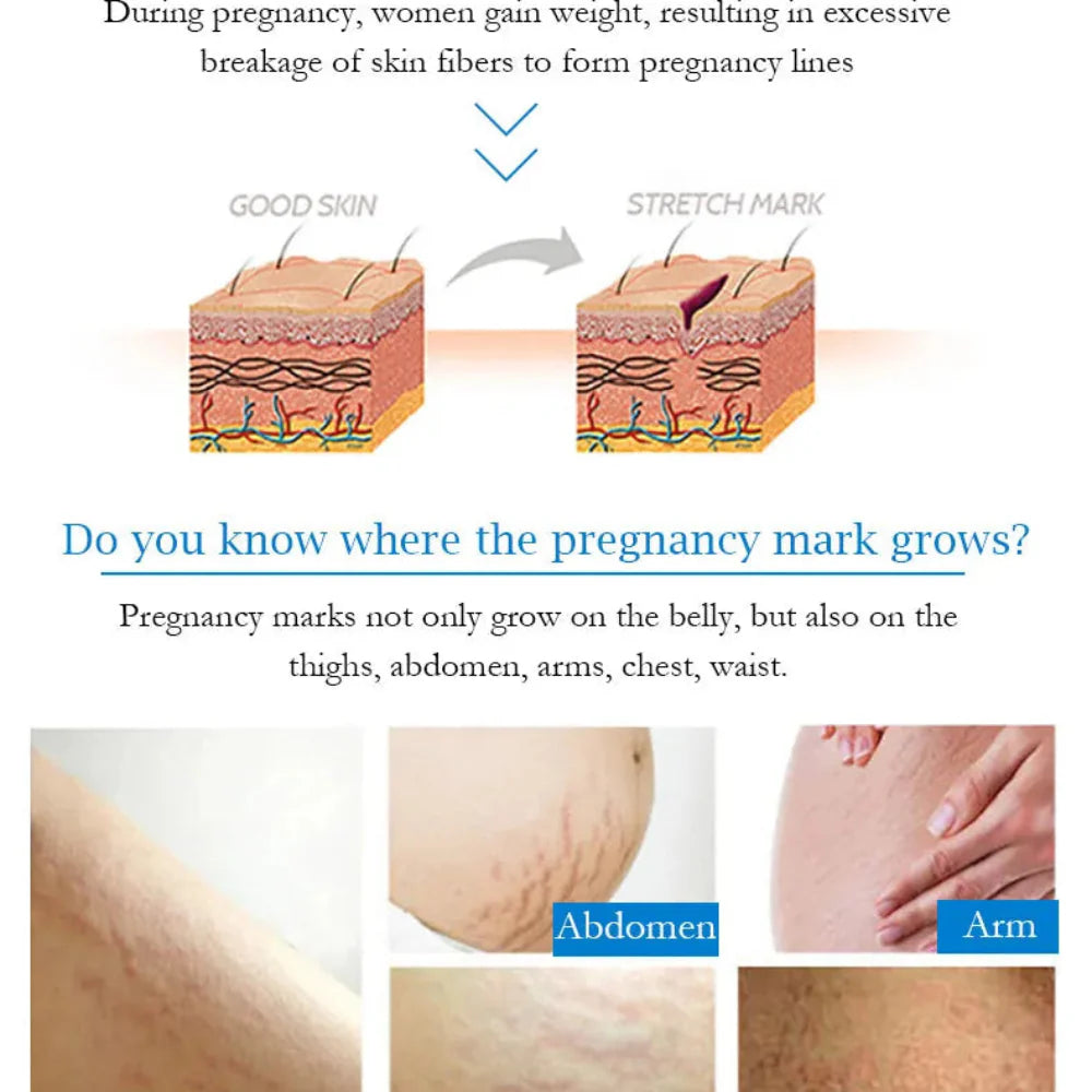 Guanjing Remove Stretch Marks Cream - 80g Guanjing