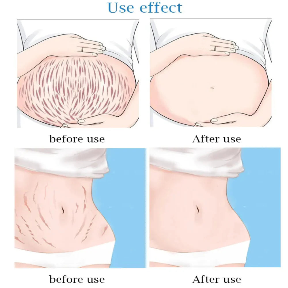 Guanjing Remove Stretch Marks Cream - 80g Guanjing