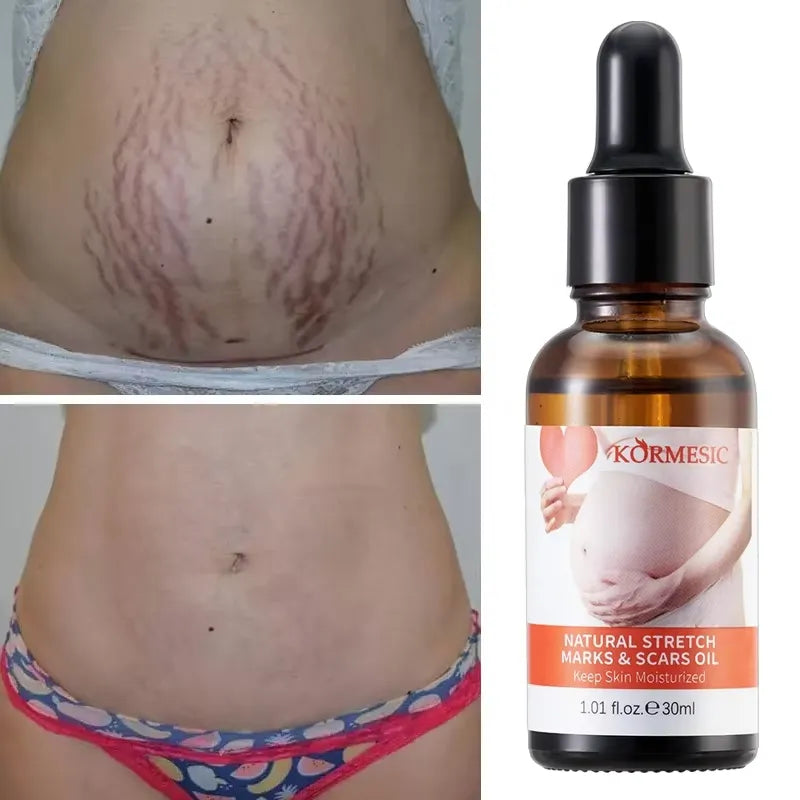 KORMESIC Skincare for Natural Belly Care Remover Stretch Mark Oil - 100ml KORMESIC