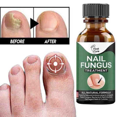 Fast Nail Fungal Treatments Nail Repair Essences Serum foot cure