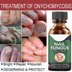 Fast Nail Fungal Treatments Nail Repair Essences Serum foot cure