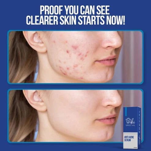 Wiki Special Anti Acne Serum - 30ml Wiki