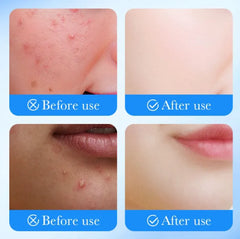 Sadoer Remove Face Acne 36 Patches Sadoer