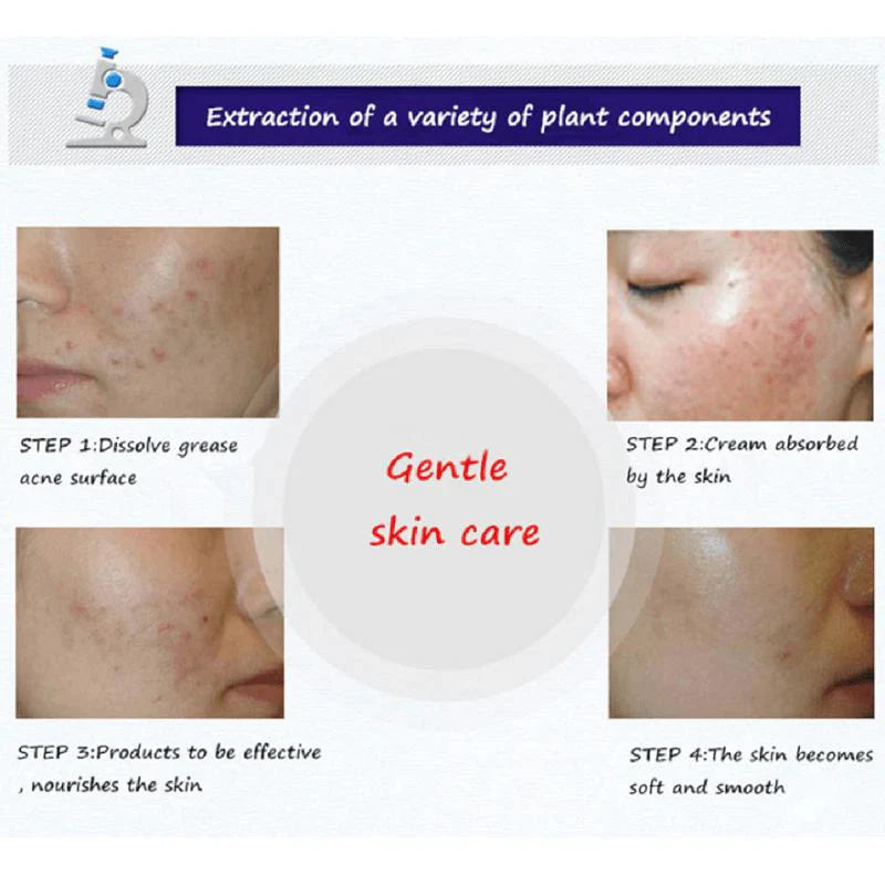 BIOAQUA Moisturizing Rejuvenating Acne Cream - Soothing & Blemish Bioaqua