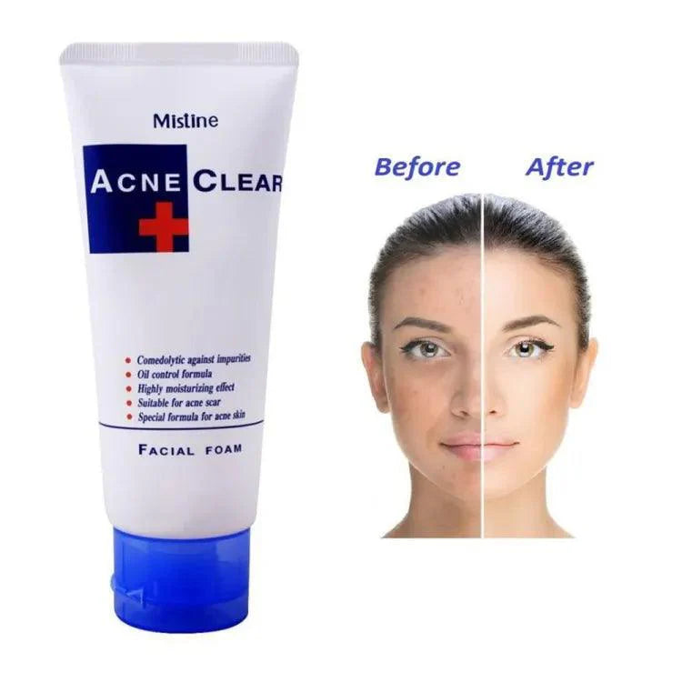 Mistine Acne Clear Facial Foam - 85ml Mistine