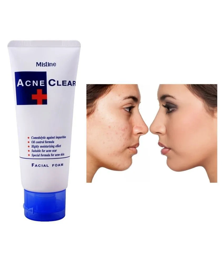 Mistine Acne Clear Facial Foam - 85ml Mistine