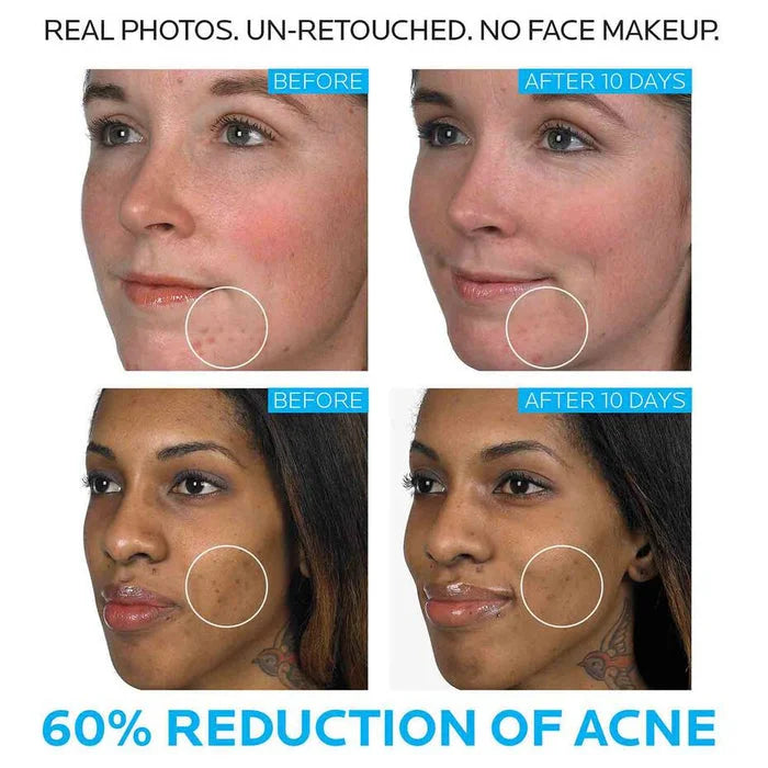 La Roche Posay Effaclar Duo Acne Spot Treatment 40ml La Roche Posay