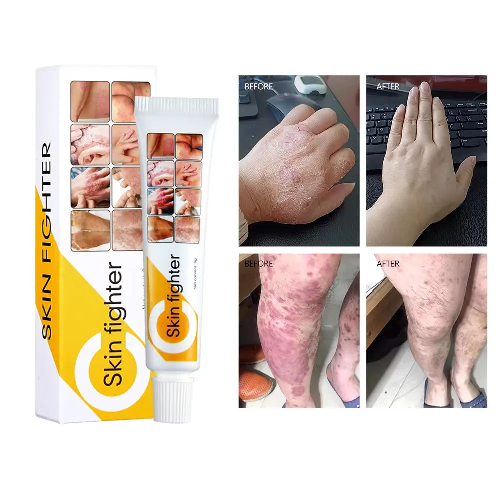 Skin Fighter Herbal Repair Ointment - Each Skin Fighter
