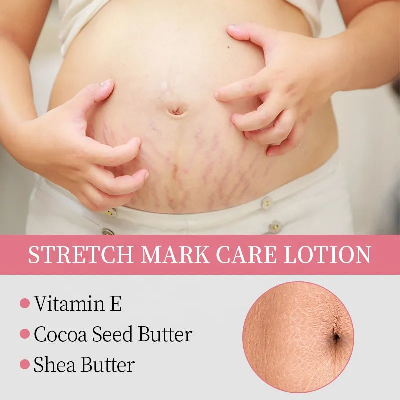 KORMESIC Stretch Mark Care Lotion – 200ml KORMESIC